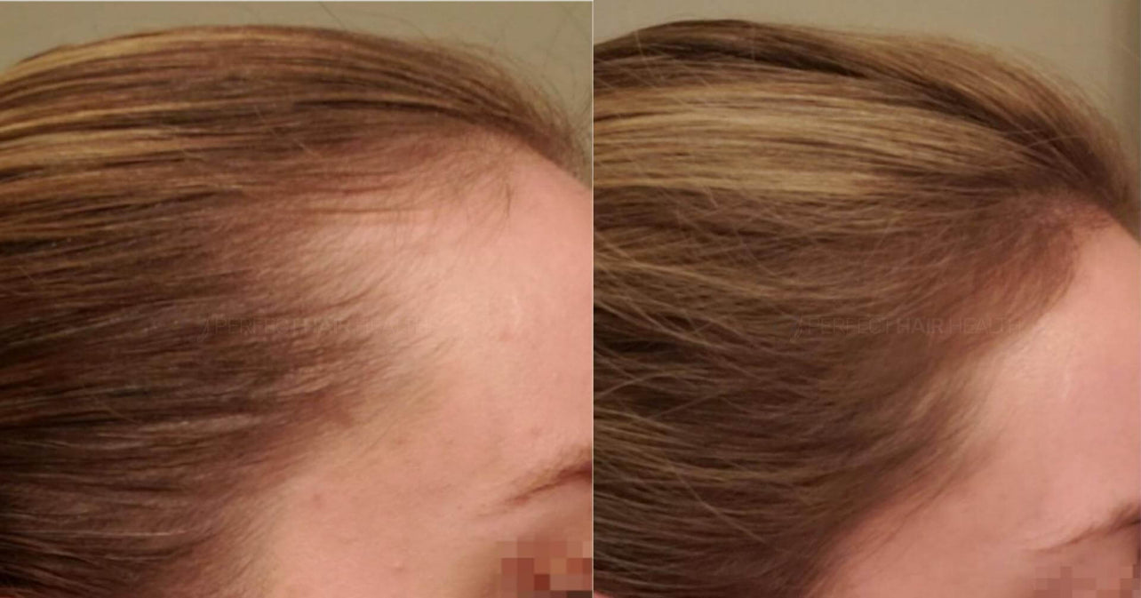 Ultimate Hair Growth OIl